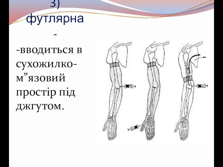 3) футлярна- -вводиться в сухожилко-м”язовий простір під джгутом.