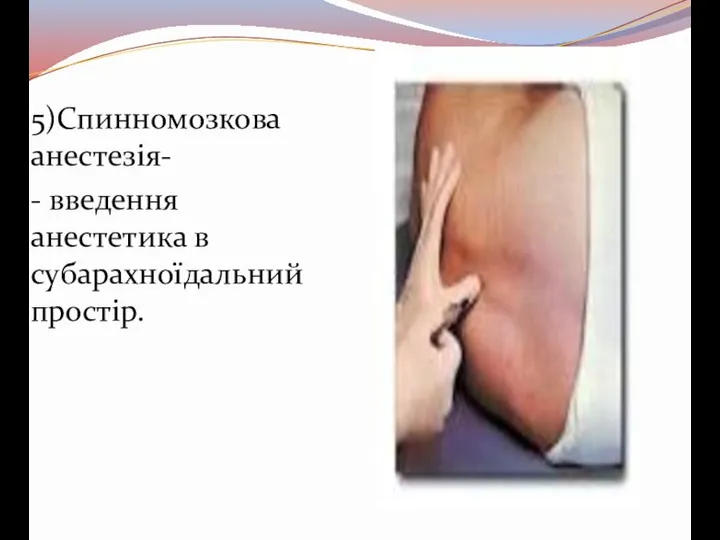 5)Спинномозкова анестезія- - введення анестетика в субарахноїдальний простір.