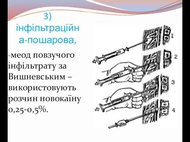 3) інфільтраційна-пошарова, -меод повзучого інфільтрату за Вишневським – використовують розчин новокаїну 0,25-0,5%.