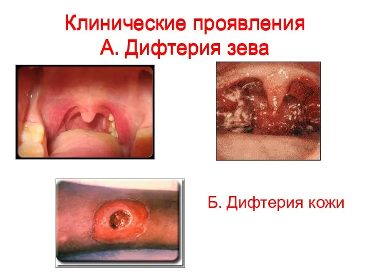 Клинические проявления А. Дифтерия зева Клинические проявления А. Дифтерия зева Б. Дифтерия кожи