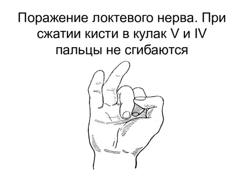 Боль при сжатии кисти в кулак. Кисть при поражении локтевого нерва. Клинические проявления поражения локтевого нерва. Тест сжатия при ревматоидном артрите. Поражение локтевого нерва пробы.