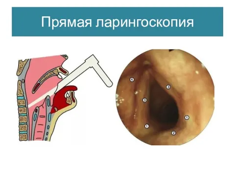 Ларингоскопия. Ретроградная фиброларингоскопия. Гортань непрямая ларингоскопия. Подскладочный ларингит ларингоскопия. Параличи гортани ларингоскопия.