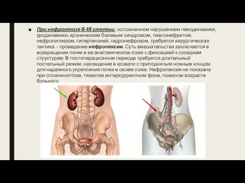 Степени нефроптоза