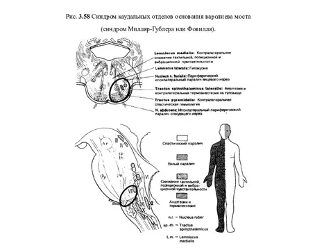 Синдром фовилля