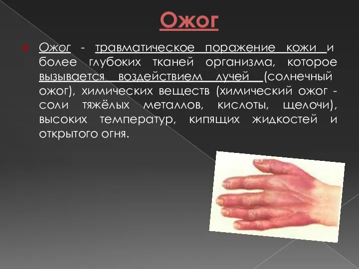 Ожоги: виды и первая помощь презентация