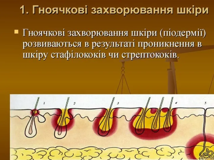 Гноячкові захворювання презентация
