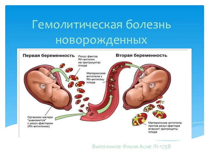 Гемолитическая болезнь новорожденных