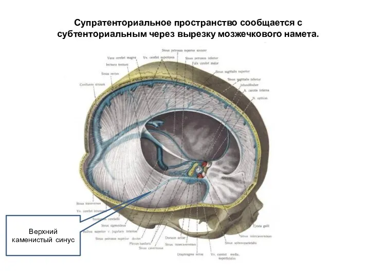 Поперечный синус слева. Супратенториальное пространство. Каменистый синус. Верхний Каменистый синус. Борозда Каменистого синуса.