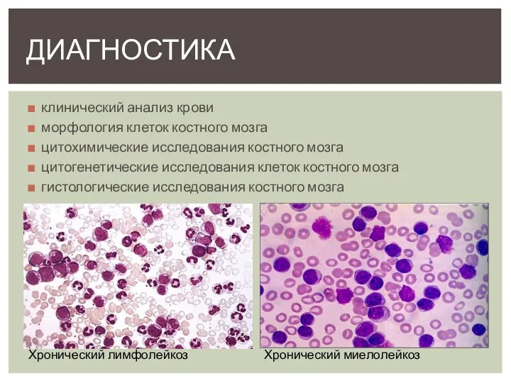 Морфология клеток крови. Морфология клеток костного мозга. Хронический лимфолейкоз костный мозг. Хронический миелолейкоз гистология костного мозга.