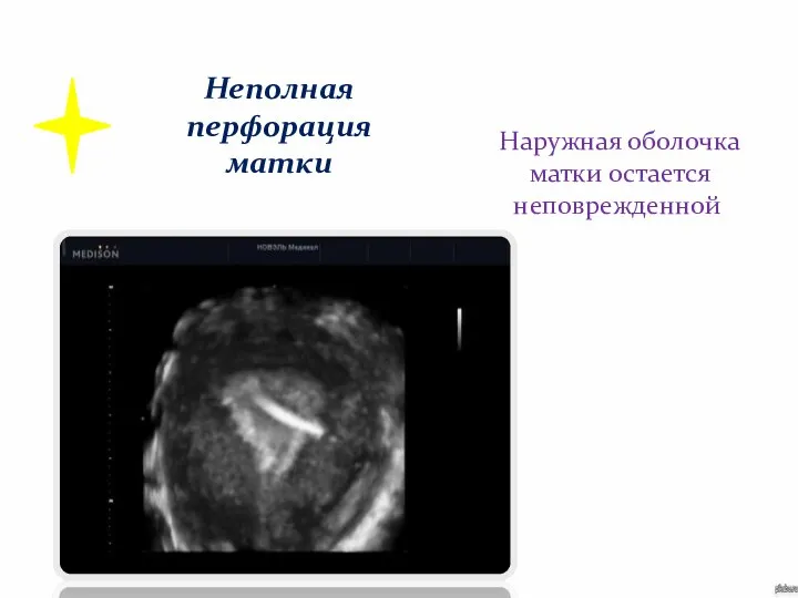 Наружная оболочка матки