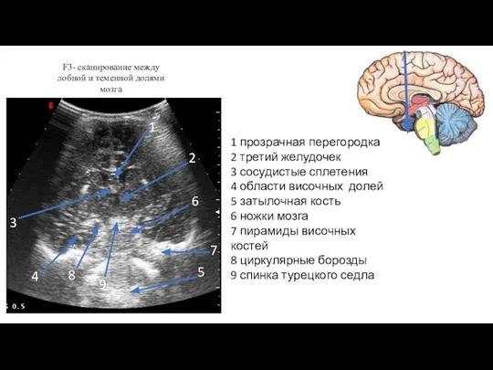 Полость прозрачной перегородки что это. Киста прозрачной перегородки головного мозга на мрт. Киста промежуточного паруса головного мозга кт. Полость прозрачной перегородки что это. Ликворная киста промежуточного паруса.