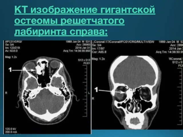 Клетки решетчатого лабиринта. Остеома лобной пазухи кт. Клиновидная пазуха на кт. Опухоли верхнечелюстной пазухи на кт. Клиновидная пазуха носа на кт.